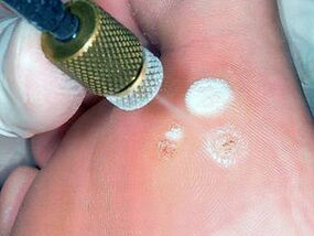 La cryodestruction comme méthode d'élimination des verrues plantaires